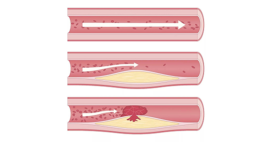 動(dòng)脈硬化過(guò)程 動(dòng)脈硬化過(guò)程